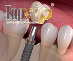 Dịch vụ trồng răng implant uy tin Quảng Bình